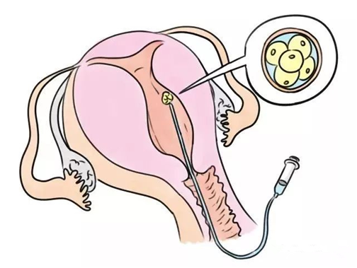 AMH0.68卵巢早衰3年，试管两次失败，泰国求子儿女双全